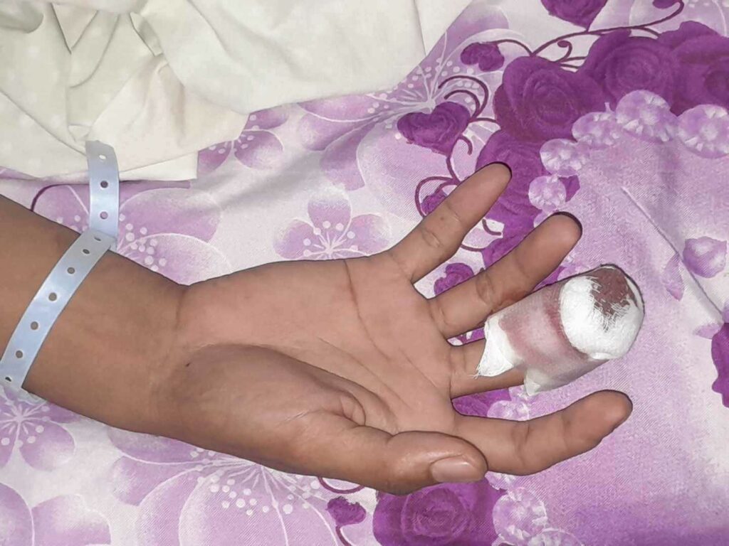 The right hand of Patrolman Gilbert Ajeno of Lambunao after the treatment. | Photo forwarded to Radyo Bistado